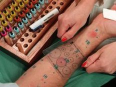 Ärzte: Vielen Allergikern kann Hyposensibilisierung helfen