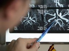 Schlaganfall Alarmzeichen Studie